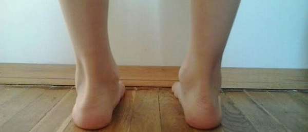 Варусная деформация ног